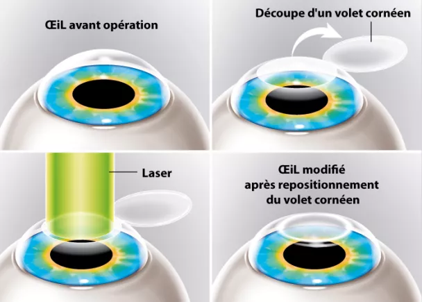 Correction de la 2025 vue au laser prix